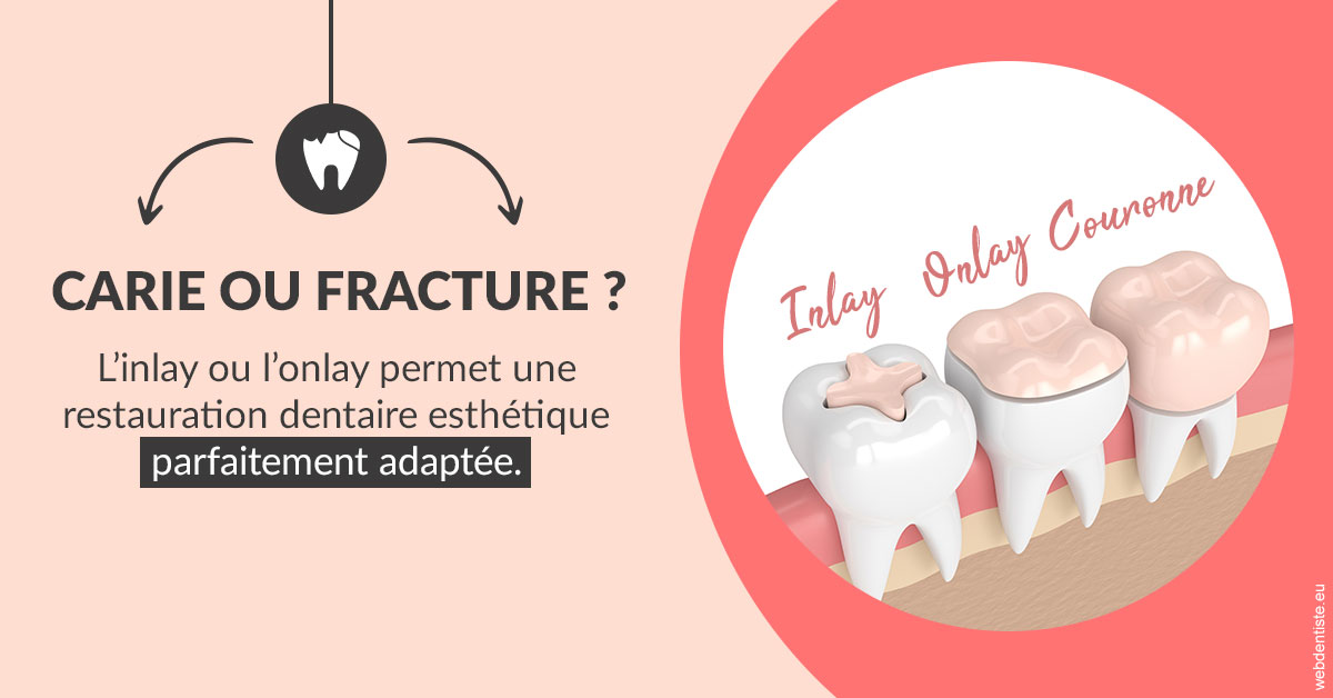 https://dr-vidal-alain.chirurgiens-dentistes.fr/T2 2023 - Carie ou fracture 2