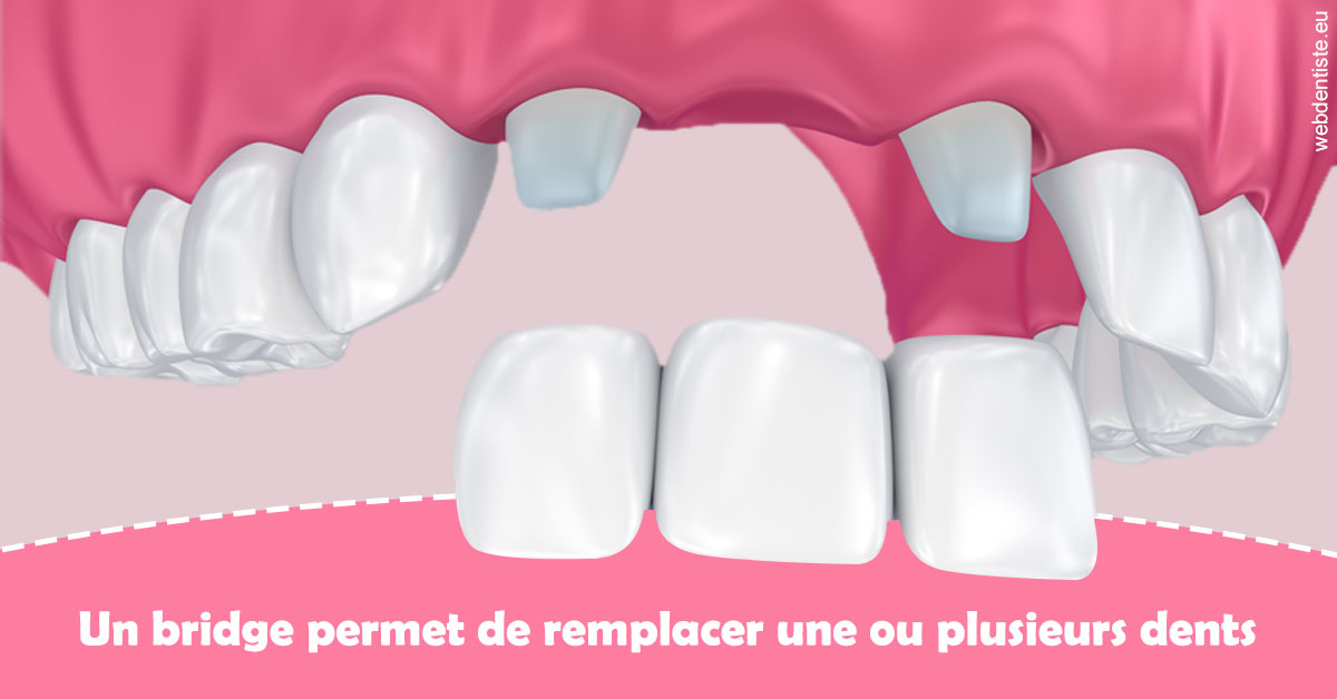 https://dr-vidal-alain.chirurgiens-dentistes.fr/Bridge remplacer dents 2