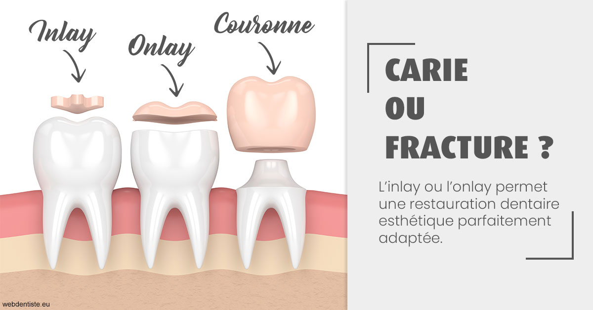 https://dr-vidal-alain.chirurgiens-dentistes.fr/T2 2023 - Carie ou fracture 1
