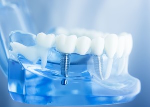 Pose d'implants dentaires à Manosque